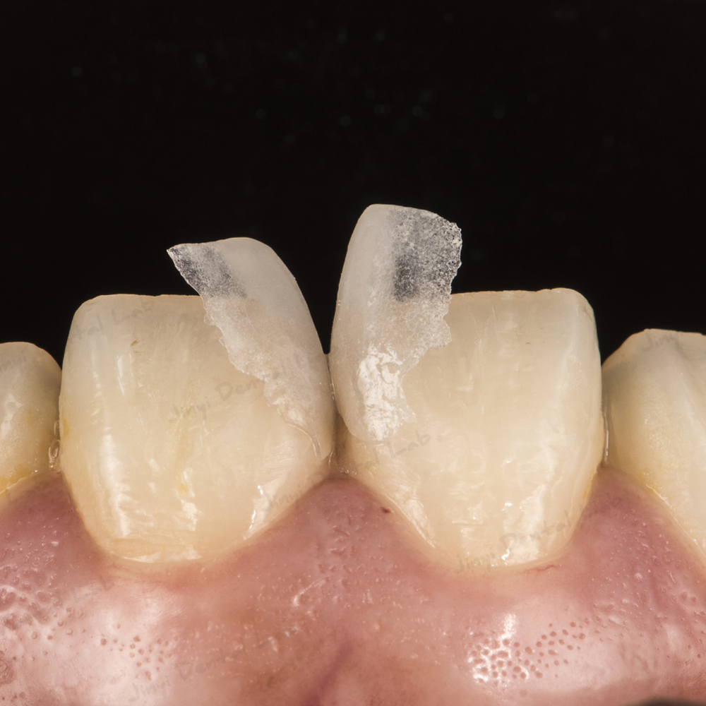 Sparse Teeth How to solve the problem of sparse teeth and large interdental spaces ...