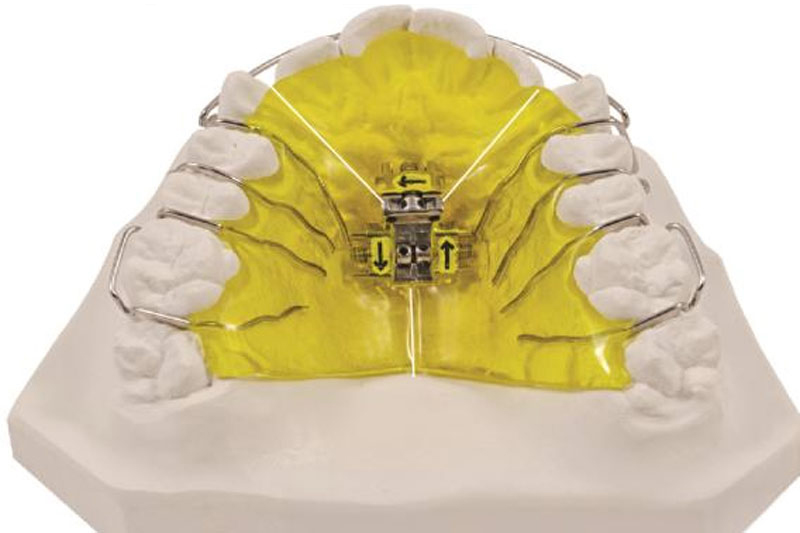 Three-Dimensional Expander: Precisely Addressing Insufficient Dental Arch Development and Crossbite Issues