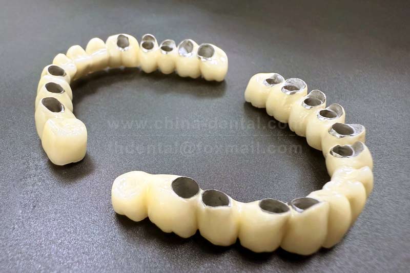 Implant-Supported Fixed Bridge: Restore a Complete Smile, Say Goodbye to the Troubles of Multiple Missing Teeth