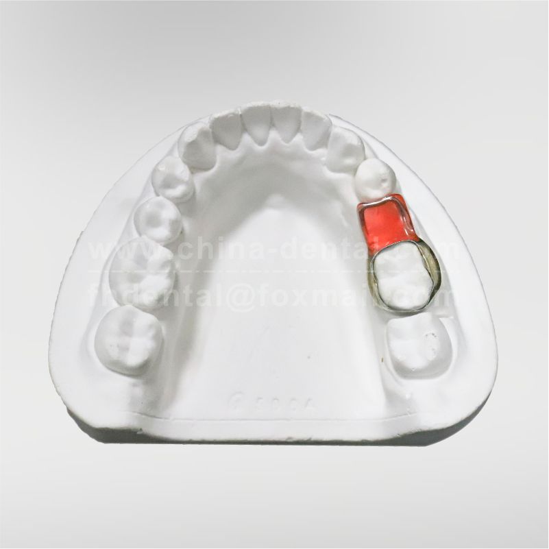 Distal Shoe Space Maintainer