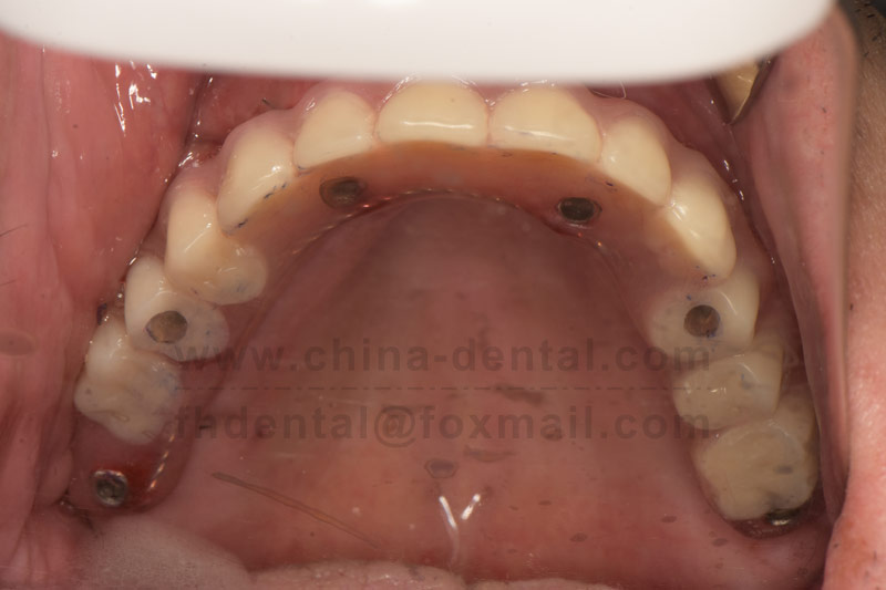 Bid farewell to the troubles of tooth loss—ALL-ON-X implants give you fixed new teeth in just one day.