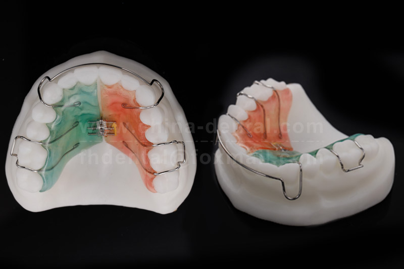 Standard Type Spiral Expander: An Ideal Choice for Scientifically Correcting Dental Arch and Improving Tooth Alignment