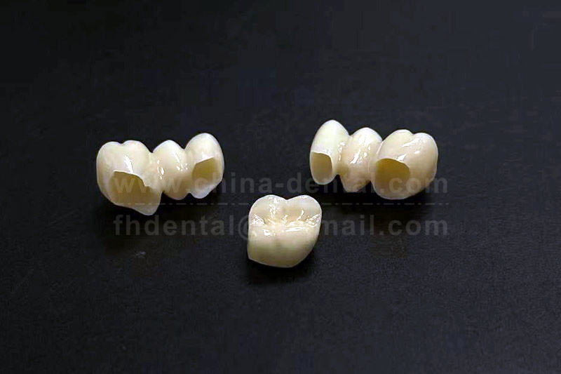 All-Ceramic Crown Fabrication: Leveraging Digital Technology for Precise and Efficient Production All-Ceramic Crown Fabrication: Leveraging Digital Technology for Precise and Efficient Production