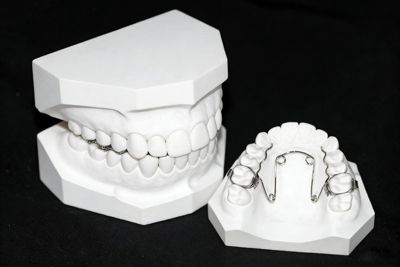 Four-Eye Spring Expander: A Reliable Choice for Controlled Arch Width Expansion