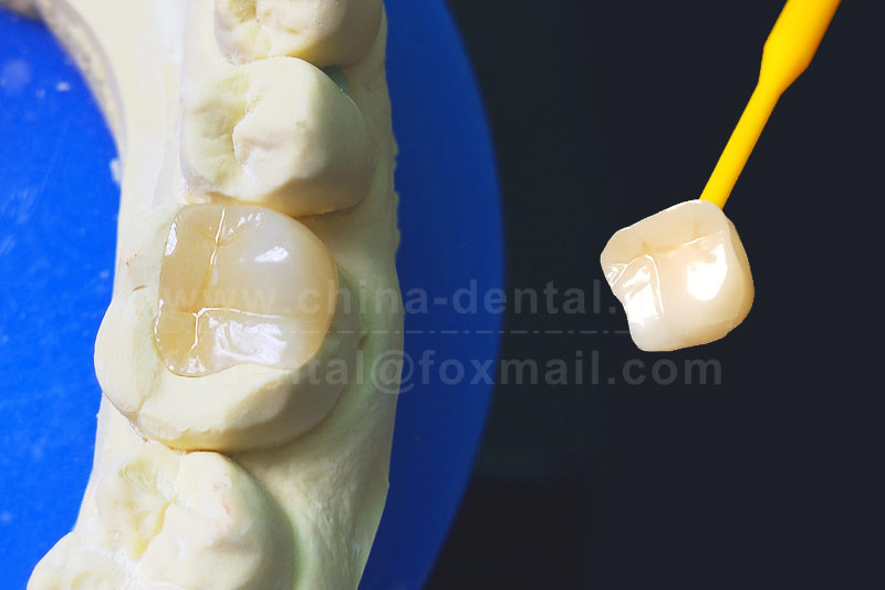 Say Goodbye to Repeated Fillings: Porcelain Inlays for Longer-Lasting Restoration Say Goodbye to Repeated Fillings: Porcelain Inlays for Longer-Lasting Restoration