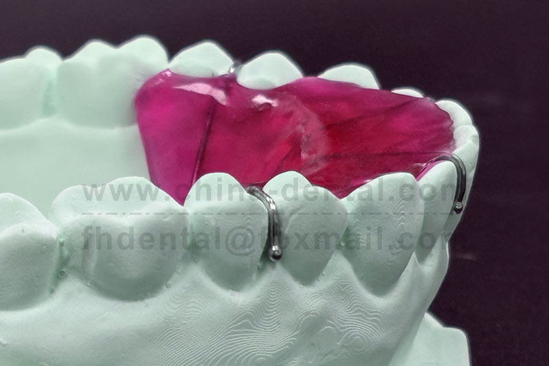 Maxillary Plane Plate – The Nemesis of Deep Overbite Correction Maxillary Plane Plate – The Nemesis of Deep Overbite Correction