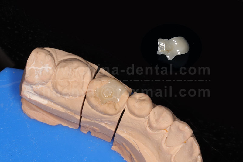 Porcelain Inlay: A Long-Lasting Restoration, Ending the Hassle of Repeated Fillings Porcelain Inlay: A Long-Lasting Restoration, Ending the Hassle of Repeated Fillings