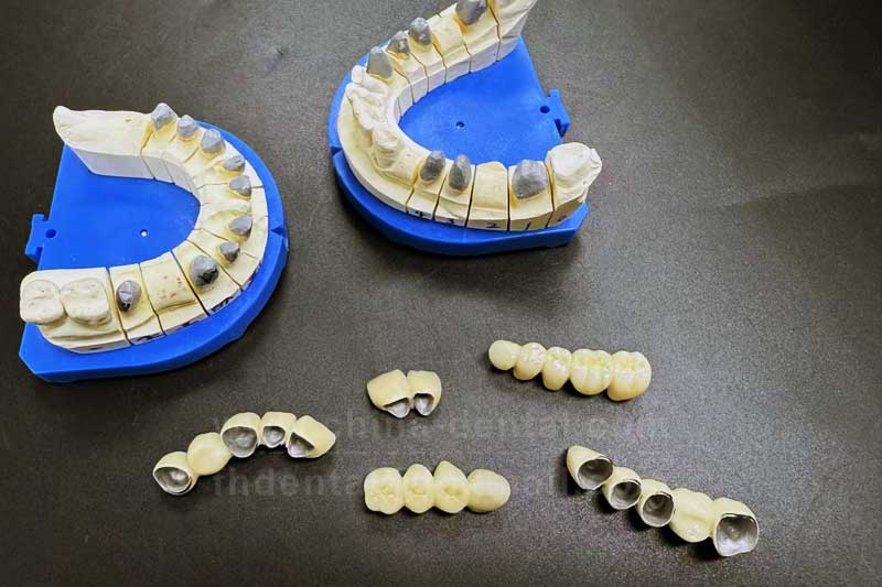 Porcelain-Fused-to-Metal Crowns: A Cost-Effective and Durable Choice for Posterior Tooth Restoration Porcelain-Fused-to-Metal Crowns: A Cost-Effective and Durable Choice for Posterior Tooth Restoration
