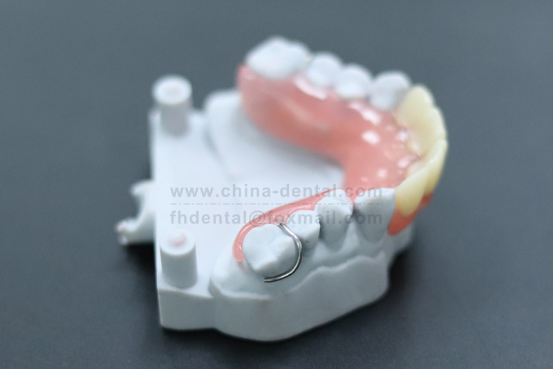 Steady as Ever, Chew with Ease: Choose Metal Clasp Removable Partial Dentures