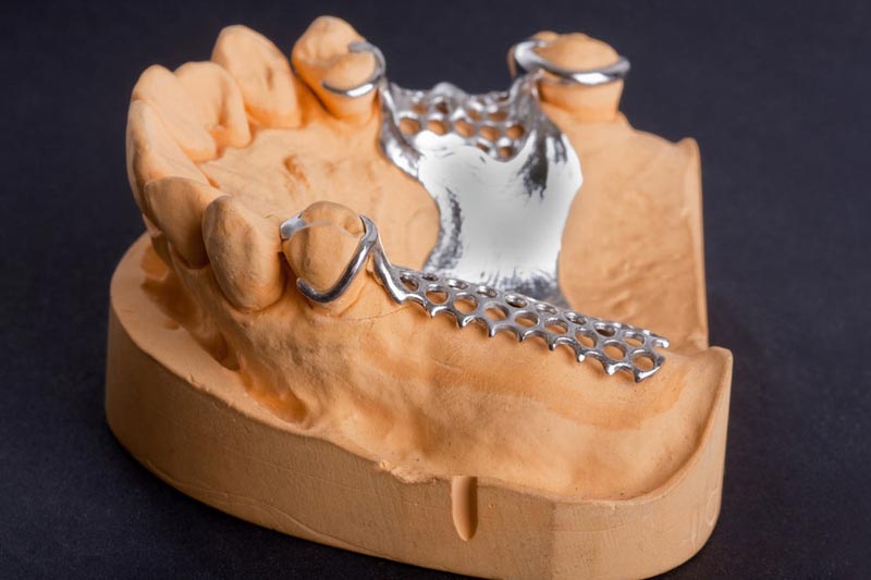 Super Titanium Framework: A Lighter, More Comfortable, and Healthier Choice for Dental Restoration