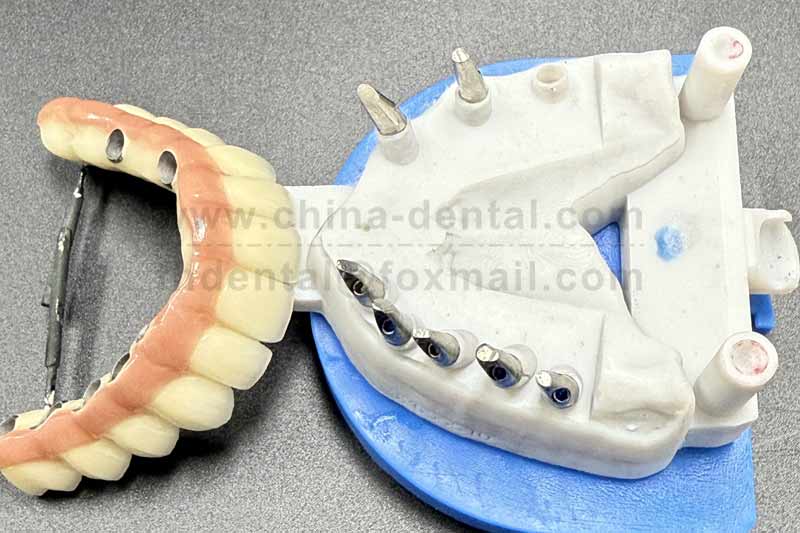  Implant-Supported Bridge: A Stable Solution for Replacing Multiple Missing Teeth
