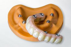 All-On-X Dental Implants: Efficient Restoration of Full Arch Function, Rediscover the Joy of Chewing