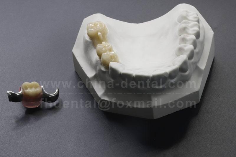 Bid farewell to the worries of looseness and experience a new sensation of stable chewing.