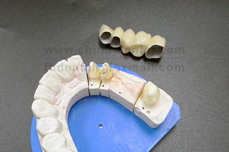 With Porcelain-Fused-to-Metal Crowns, Rediscover the Confidence of Carefree Chewing