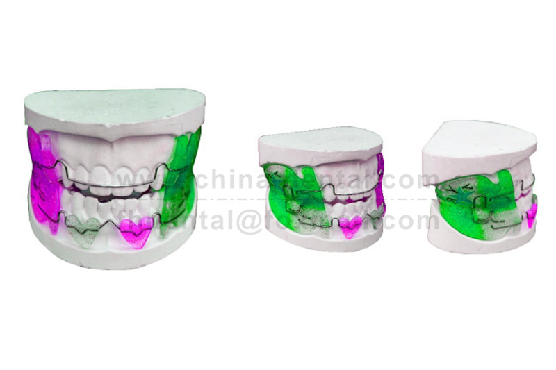 Child has protruding lips and a recessed chin? The Frankel 2 appliance guides the chin to grow forward Child has protruding lips and a recessed chin? The Frankel 2 appliance guides the chin to grow forward