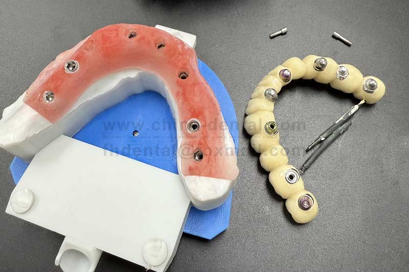 Say Goodbye to the Annoyance of Removable Dentures – Restore Stability and Comfort for Multiple Missing Teeth with Implant-Supported Bridges Say Goodbye to the Annoyance of Removable Dentures – Restore Stability and Comfort for Multiple Missing Teeth with Implant-Supported Bridges