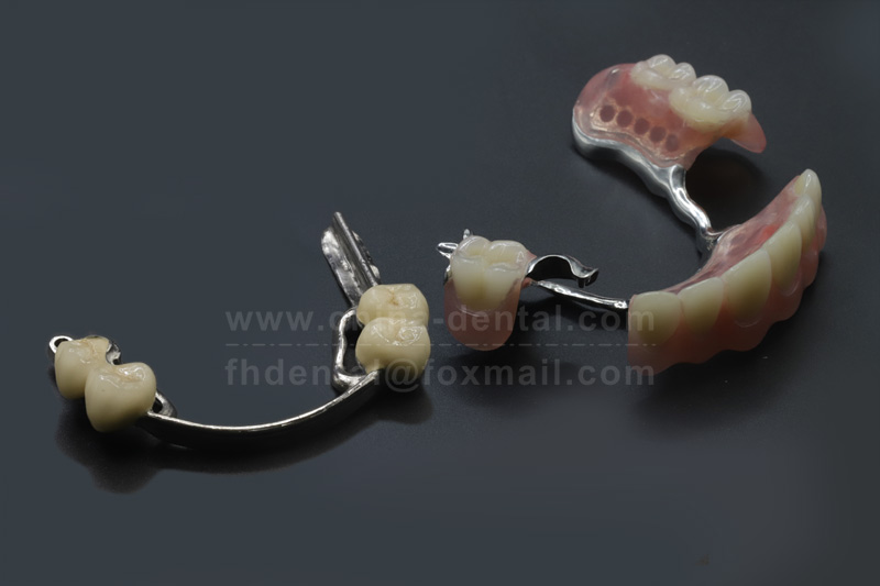 Precision Attachment Dentures: Stable and Reliable, Accompany You to Enjoy Food for a Long Time