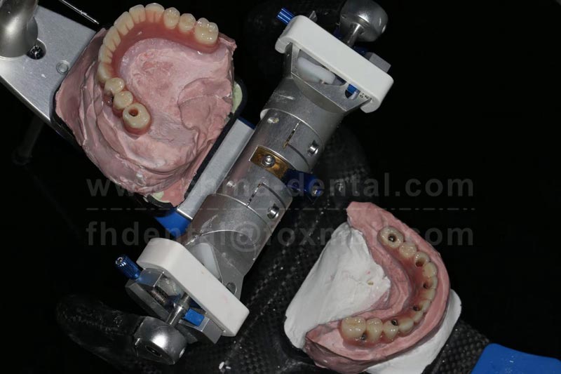 Unstable removable dentures? Dreading bone grafting? All-On-X Implants Bring a Brand-New Restoration Experience Unstable removable dentures? Dreading bone grafting? All-On-X Implants Bring a Brand-New Restoration Experience