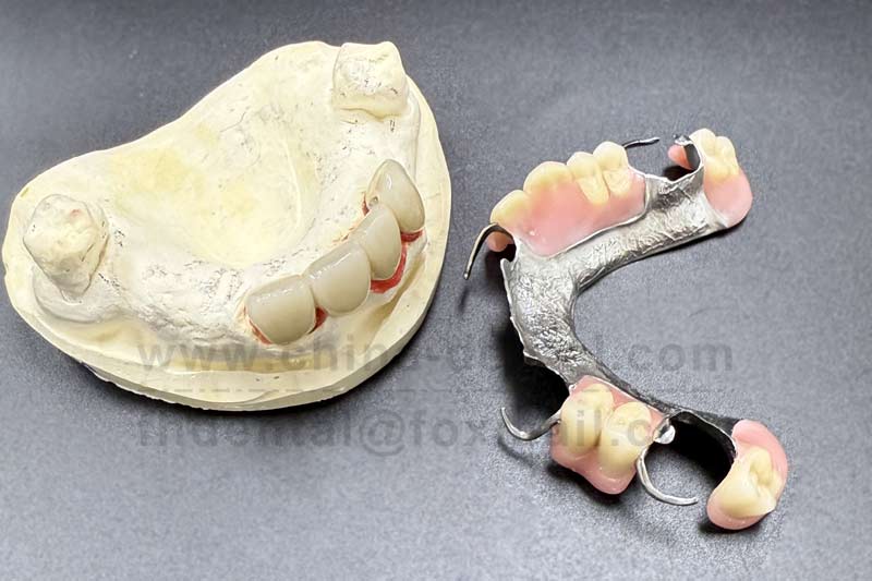 Cast Partial: A Stable Foundation for Complex Oral Conditions Cast Partial: A Stable Foundation for Complex Oral Conditions