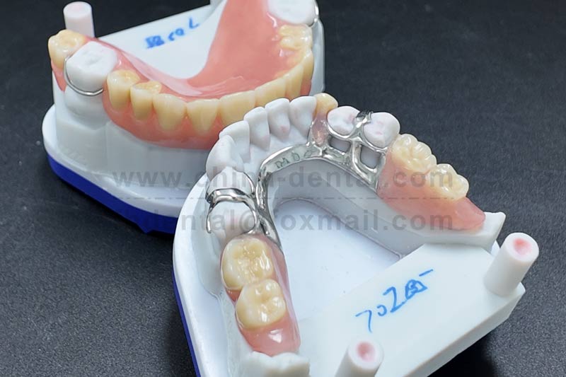 Many Missing Teeth Scattered Across the Arch? Partial Dentures Offer a Stable Restoration