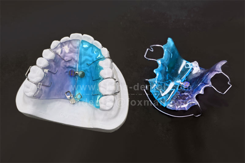 A removable appliance that children can take out and put in themselves, easily solving anterior crowding