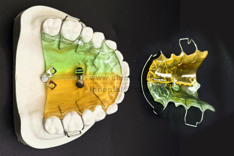 Anterior crowding in mixed dentition? The fan-shaped expander helps gradually widen the child's anterior arch.