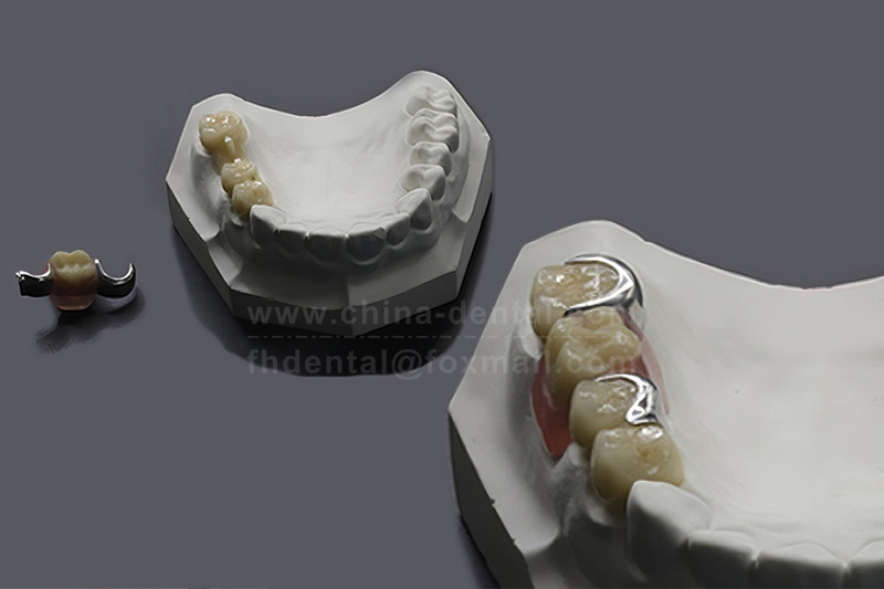 Dentures no longer wobble, thanks to Precision Attachments. Dentures no longer wobble, thanks to Precision Attachments.