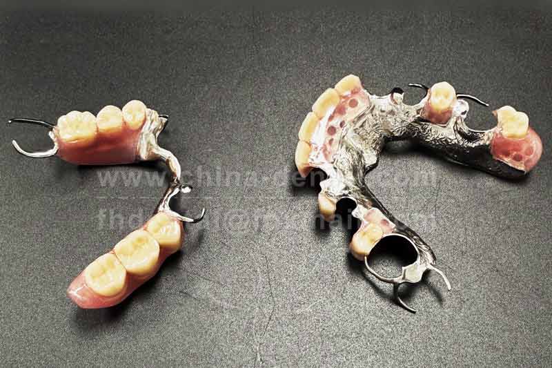 Metal Framework: A Reliable Support for Seniors' Removable Dentures – Stable and Comfortable