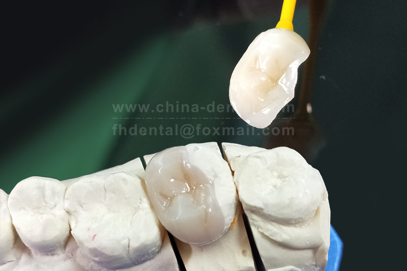 Don’t let repeated fillings drain your healthy teeth. A single ceramic inlay restoration offers lasting peace of mind.
