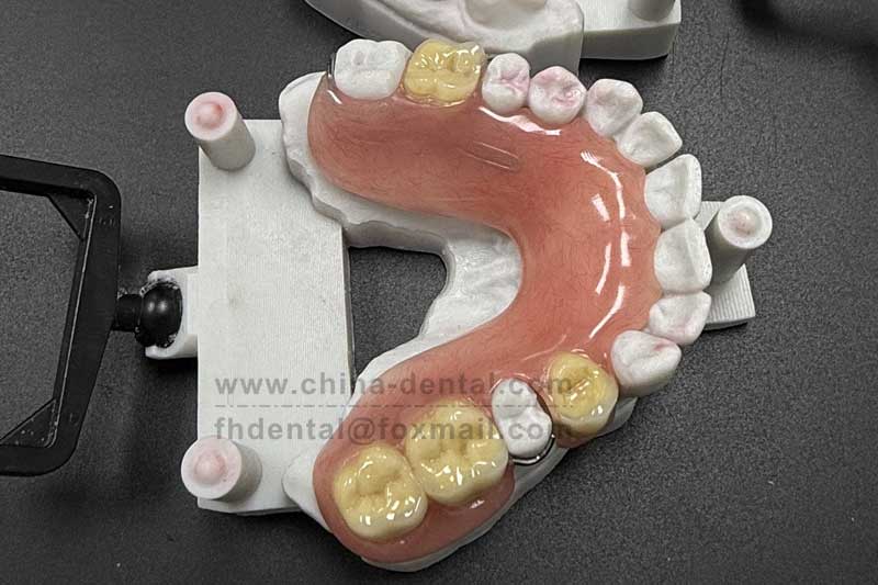 Say goodbye to tooth loss troubles, and embrace a confident smile with Acrylic Dentures.