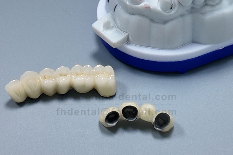 Don't Let Your Guard Down After Root Canal Treatment – A Porcelain-Fused-to-Metal Crown Armors the Weakened Tooth