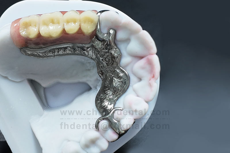 Say Goodbye to Embarrassing Looseness – Removable Partial Dentures Are Sturdy, Durable, and Worry-F