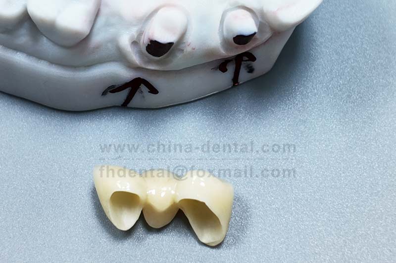 Strong, Durable, Non-Irritating: All-Ceramic Crowns Restore Oral Function and Health