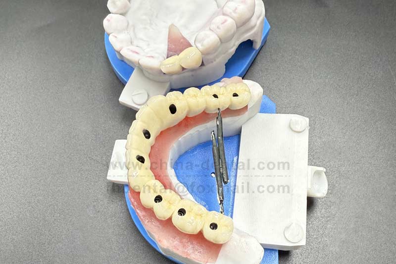 Don’t replace multiple missing teeth one by one — implant-supported bridges save you from extra s