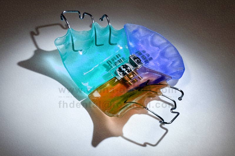 Narrow arch and crossbite? The Three-Dimensional Expander opens up space from three dimension Narrow arch and crossbite? The Three-Dimensional Expander opens up space from three dimension