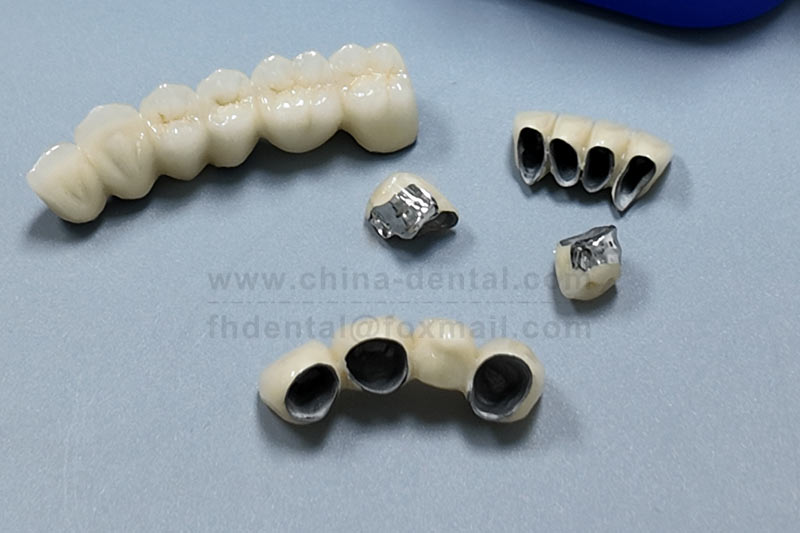 PFM Crowns – A Practical Choice Balancing Strength and Aesthetics PFM Crowns – A Practical Choice Balancing Strength and Aesthetics
