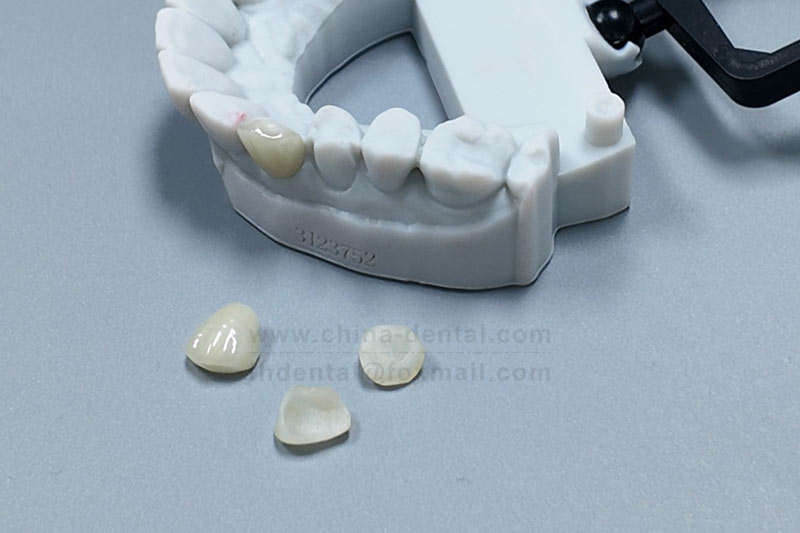 Minimal grinding, maximum transformation — porcelain veneers for a beautifully confident smile. Minimal grinding, maximum transformation — porcelain veneers for a beautifully confident smile.