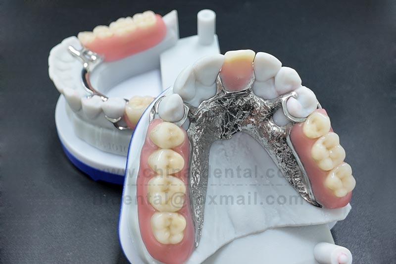 Metal Framework Partial Denture – A Stable Restoration Solution That Remains Reliable for Years Metal Framework Partial Denture – A Stable Restoration Solution That Remains Reliable for Years