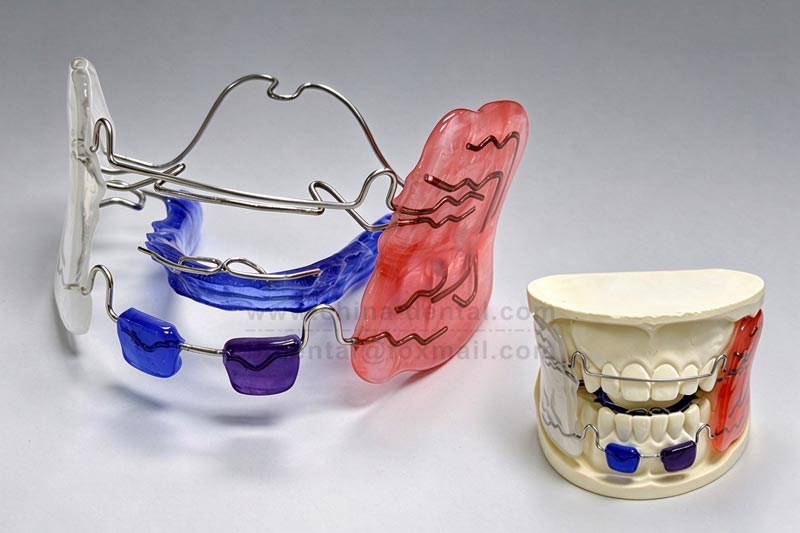 Frankel 2: Guiding Children to Improve “No Chin” and “Buck Teeth” During the Golden Growth Period