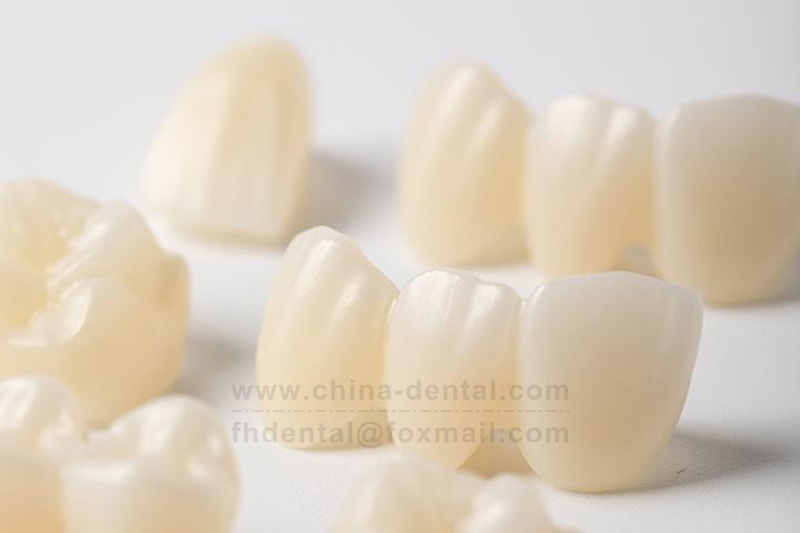 Reshaping Natural Smiles: All-Ceramic Crowns Open a New Esthetic Experience