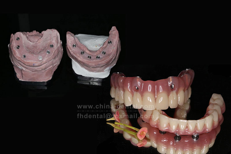 Say Goodbye to Full-Mouth Tooth Loss: ALL-ON-X Implants Help You Regain Fixed Teeth the Same Day Say Goodbye to Full-Mouth Tooth Loss: ALL-ON-X Implants Help You Regain Fixed Teeth the Same Day