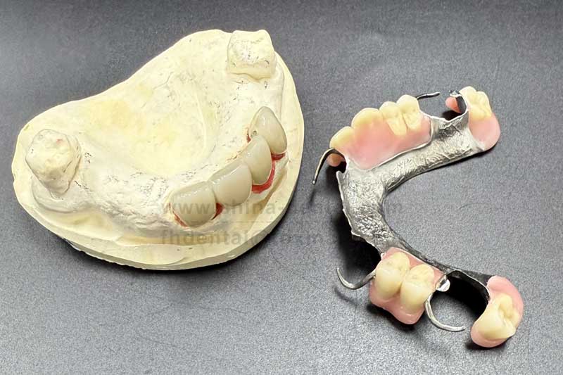 Multiple Missing Teeth in Scattered Positions: A Partial Denture Can Help You Regain Confidence in Chewing Multiple Missing Teeth in Scattered Positions: A Partial Denture Can Help You Regain Confidence in Chewing